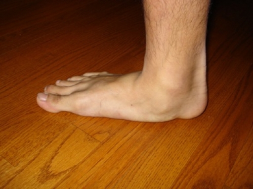 Có nhiều loại bàn chân bẹt (phẳng)