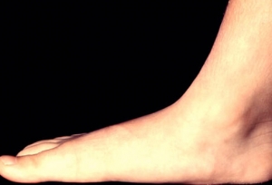 Hội chứng bàn chân bẹt ( phẳng) là gì?