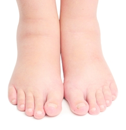 Description: D:\hinhanh\mẫu lgiay & dép\Swollen-feet-and-ankle.png
