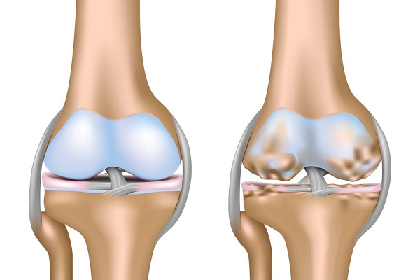 Sụn khớp bọc ở hai đầu xương bị hao mòn gia tăng nguy cơ mắc các bệnh về khớp